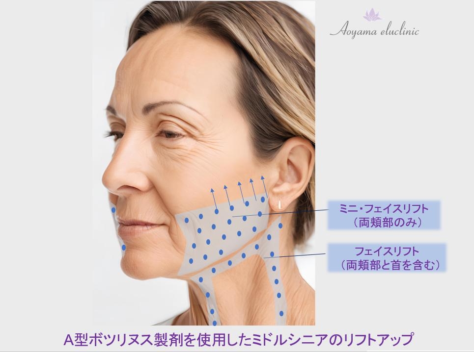 ボツリヌスリフト