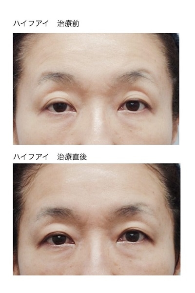 ハイフ・アイ症例1 治療前・治療直後