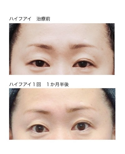 ハイフ・アイ症例2 治療前・1か月半後