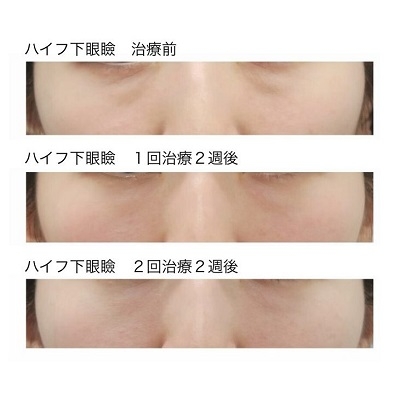 ハイフ・下眼瞼症例1 治療前・1回治療2週後・2回治療2週後