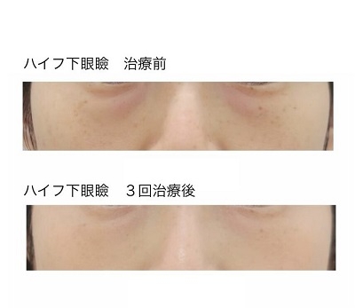 ハイフ・下眼瞼症例2 治療前・3回治療後