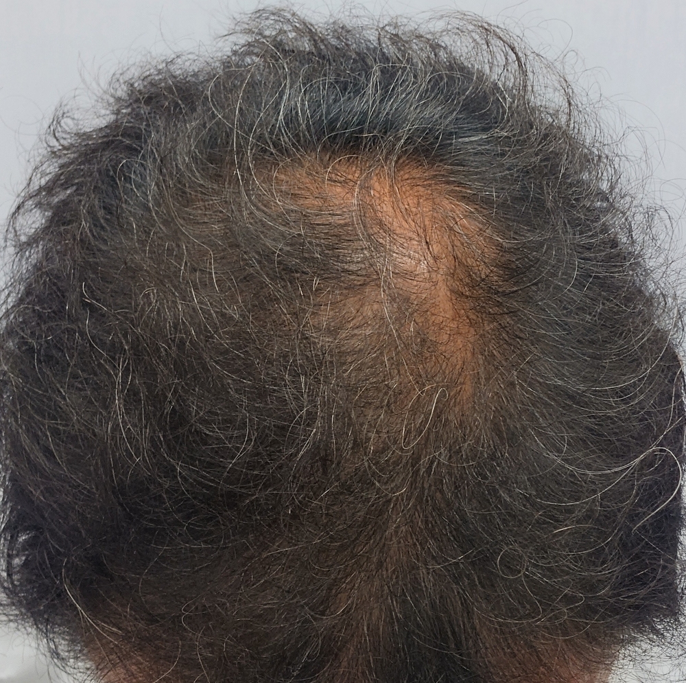 One month after treatment