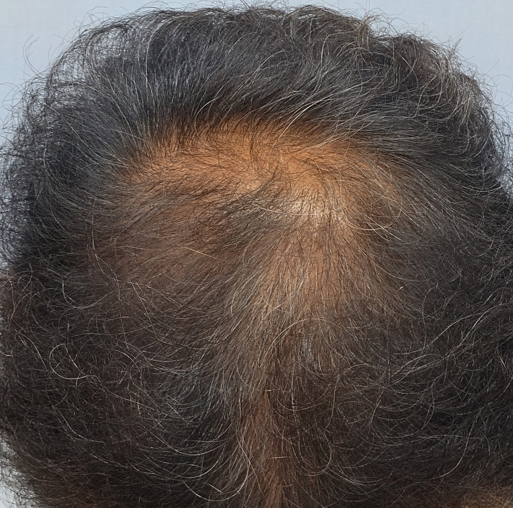Before treatment