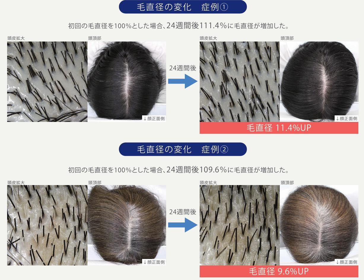 ウィンセル育毛