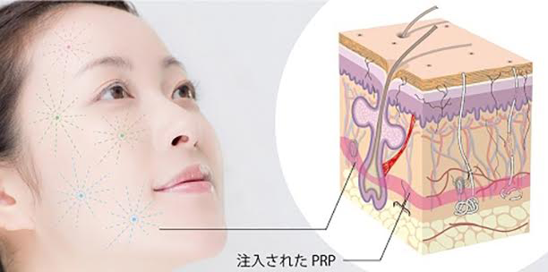 PRP治療（皮膚の再生治療） 
