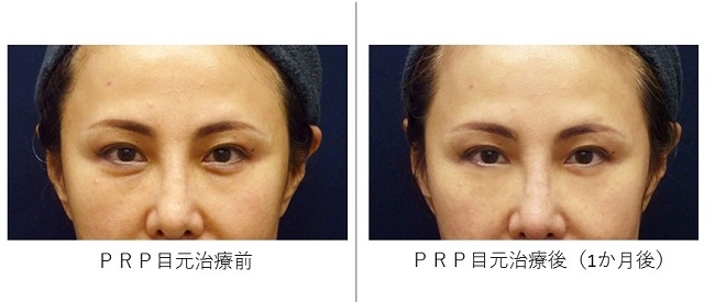 PRP症例2 目元治療前と1か月後の比較