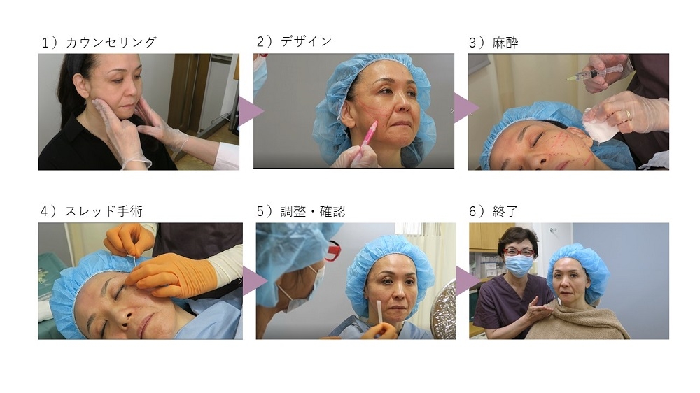 スレッドリフト治療の流れ カウンセリング・デザイン・麻酔・手術・調整・終了