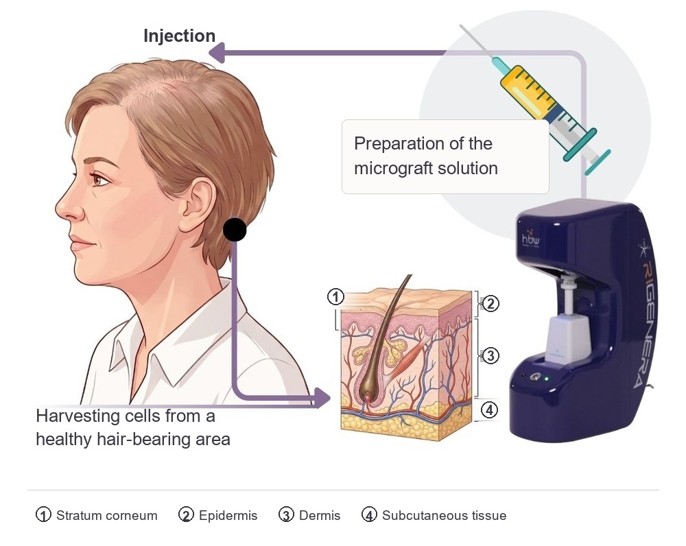 How micrograft therapy works